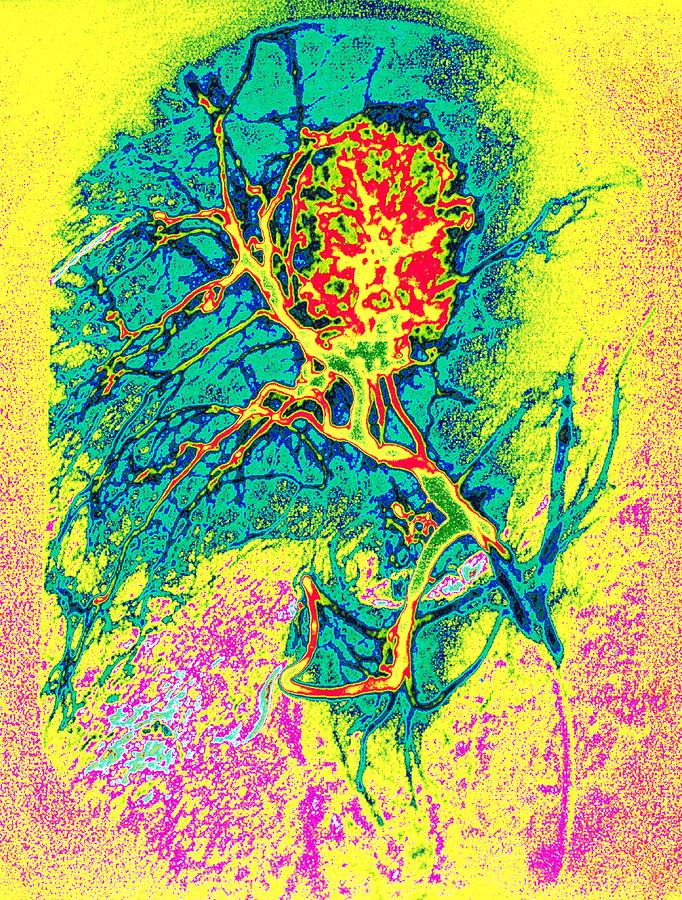 Liver Cancer Photograph - Coloured Angiogram X-ray Of A Tumour In The Liver by Mehau Kulyk/science Photo Library Liver Cancer Photograph - Coloured Angiogram X-ray Of A Tumour In The Liver by Mehau Kulyk/science Photo Library