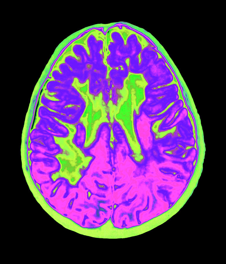Coloured Mri Brain Scan Showing Multiple Sclerosis #1 Photograph by Mehau Kulyk/science Photo Library