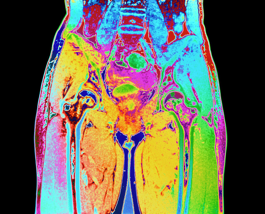 Coloured Mri Of A Section Through Hips Of Woman Photograph By Simon Fraserscience Photo Library 