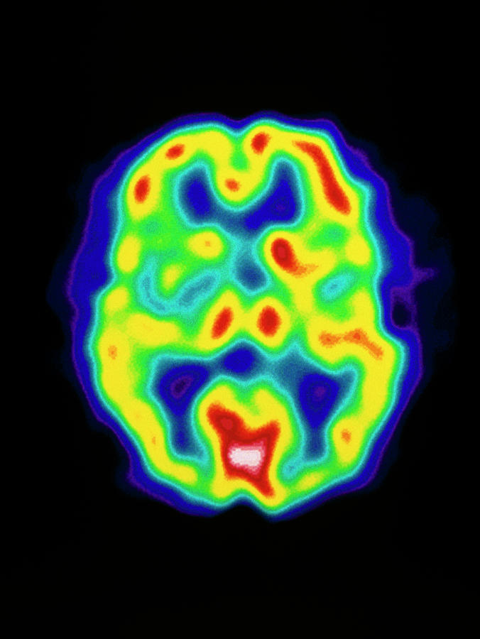Coloured Pet Scan Of The Brain Of A Stroke Patient #1 Photograph by Dept. Of Nuclear Medicine, Charing Cross Hospital/science Photo Library