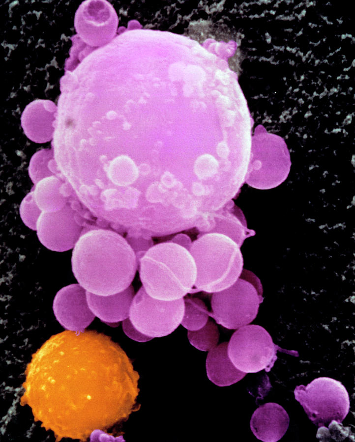 Cancer Cell Photograph - Coloured Sem Of Lymphocyte Attacking Cancer Cell #1 by Dr Andrejs Liepins/science Photo Library