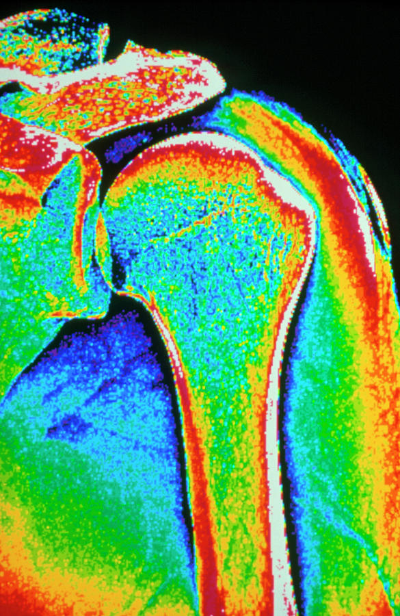Coloured X-ray Of Human Shoulder Joint #1 Photograph by Gca/science Photo Library