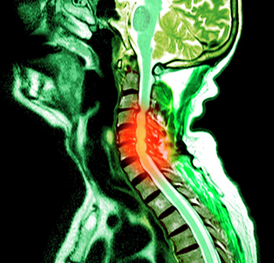 Compressed Spinal Cord Photograph by Du Cane Medical Imaging Ltd - Pixels