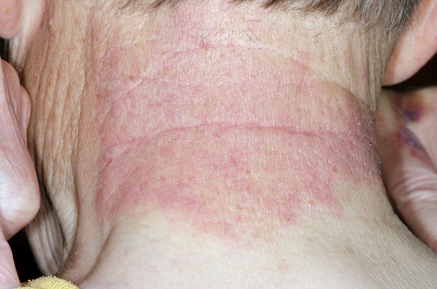 Contact Dermatitis On The Neck Photograph by Dr P. Marazzi/science ...