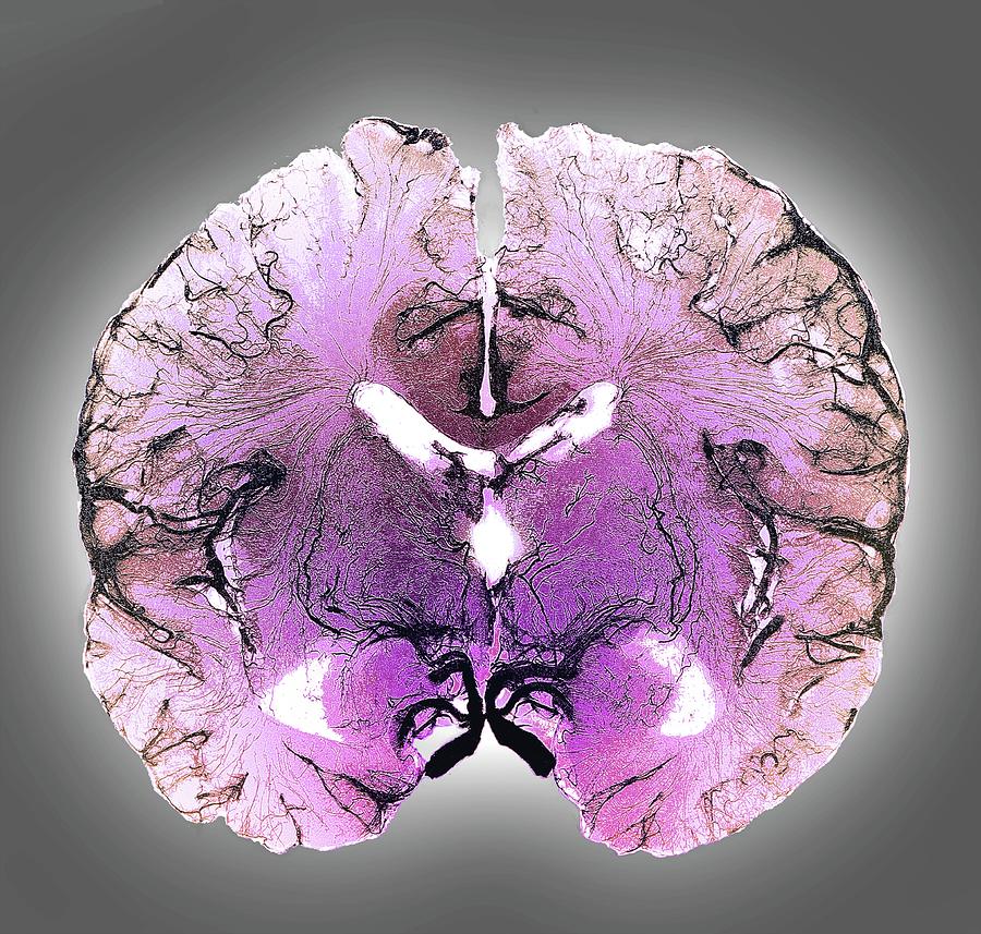 Coronal Brain Slice Specimen #1 Photograph by Zephyr/science Photo Library