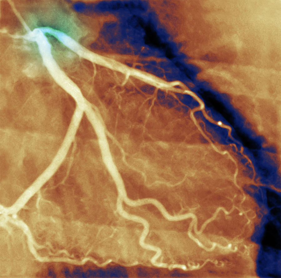 Coronary Artery Disease #1 Photograph by Voisin/Phanie