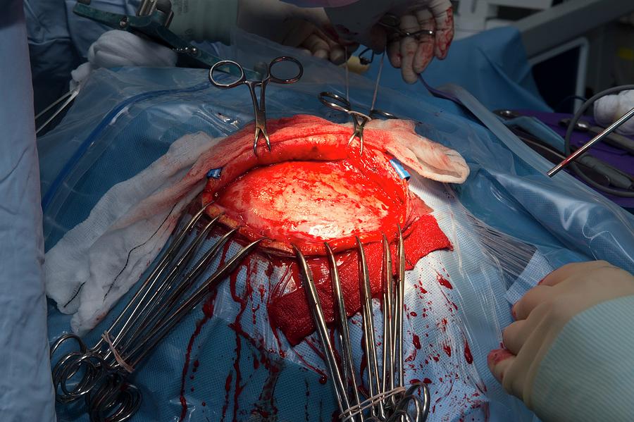 Craniotomy Brain Surgery Photograph by Dr P. Marazzi.