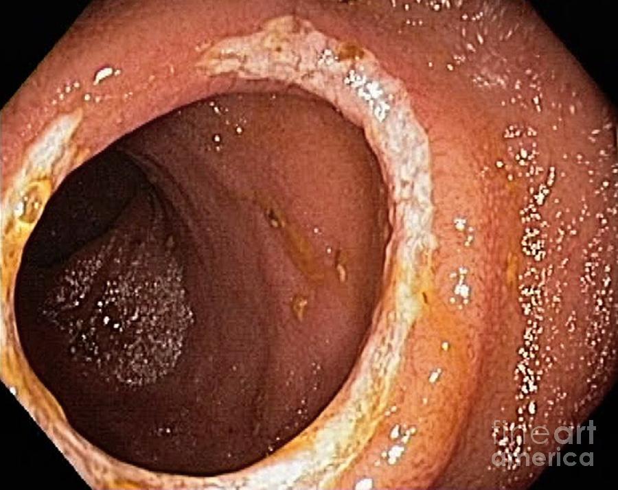Digestive System Photograph - Crohns Disease, Endoscopic View #1 by Gastrolab