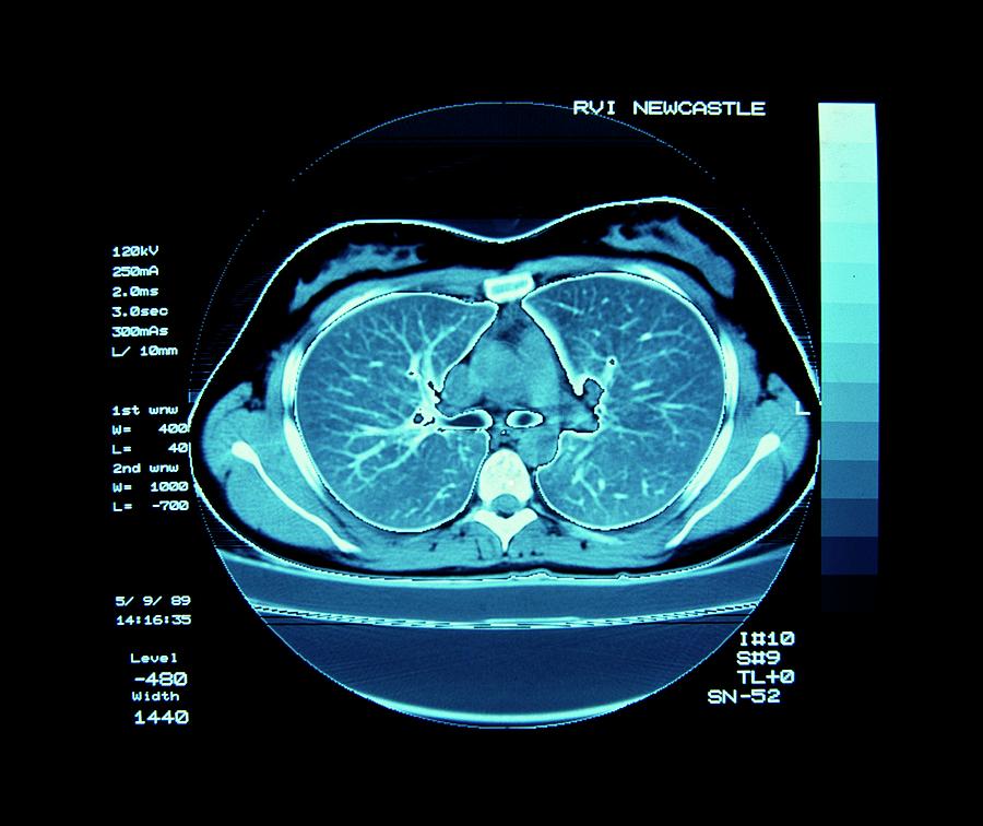 Ct Scan Showing Normal Lungs Photograph By Simon Fraser Science Photo