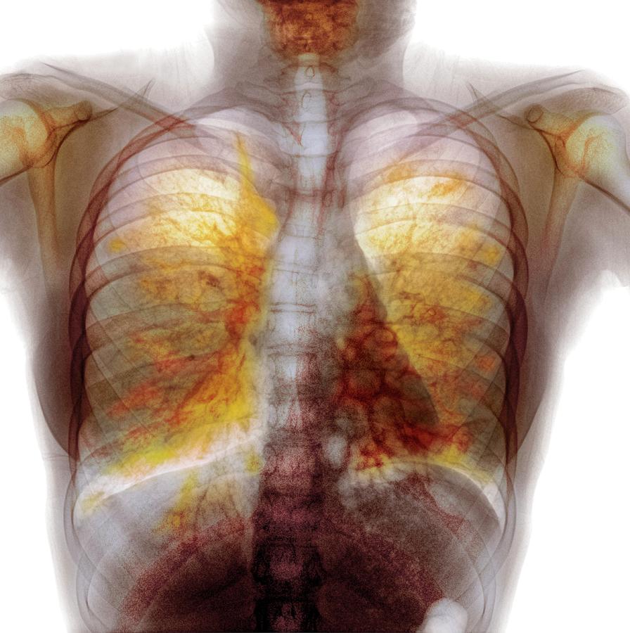 Cystic Fibrosis #1 Photograph by Photostock-israel/science Photo Library