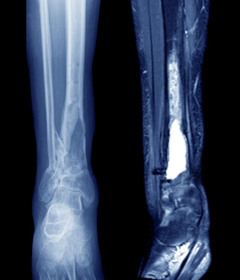 Black And White Photograph - Damaged Tibia #1 by Zephyr/science Photo Library