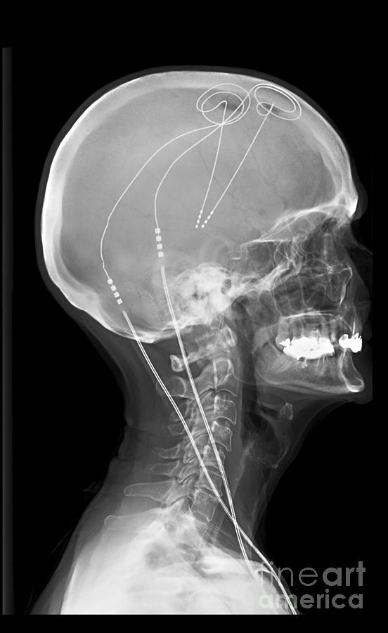 Deep Brain Stimulating Electrodes, X-ray #1 Photograph by Living Art Enterprises