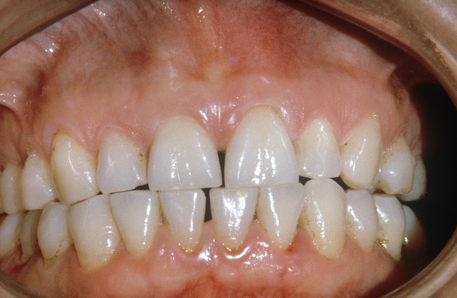People Photograph - Dental Abrasion #1 by Dr. J.p. Casteyde/cnri
