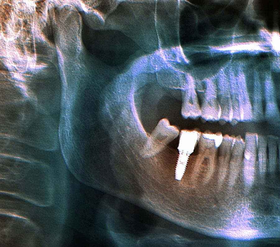 Coloured Photograph - Dental Implant #1 by Zephyr