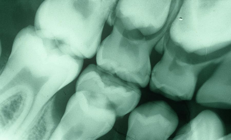 6 Photograph - Dental X-ray #1 by Dr. J.p. Casteyde - Cnri
