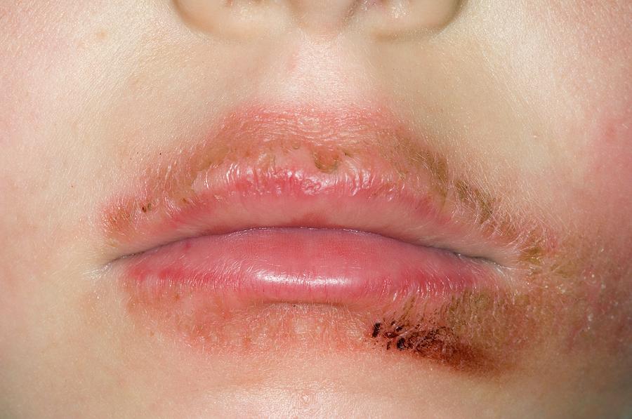 dermatitis-around-the-mouth-photograph-by-dr-p-marazzi-science-photo