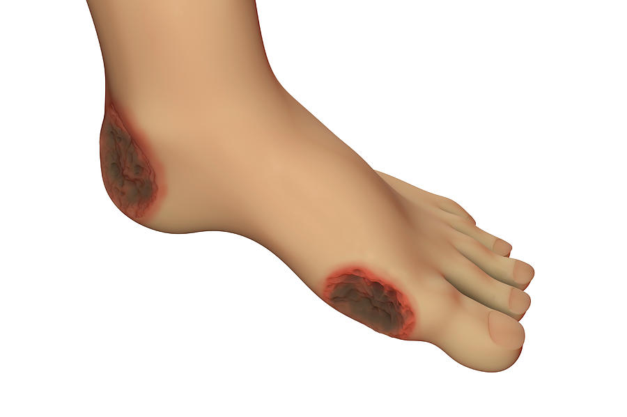 Diabetic Foot Ulcers 1 Photograph By Kateryna Kon Science Photo