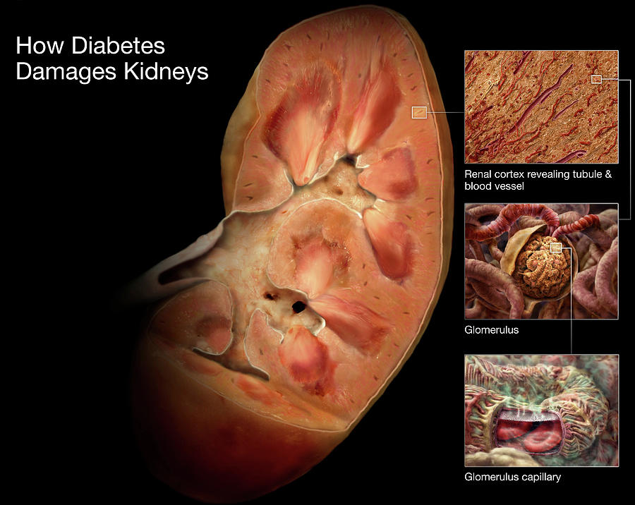 diabetic-kidney-damage-photograph-by-anatomical-travelogue-pixels