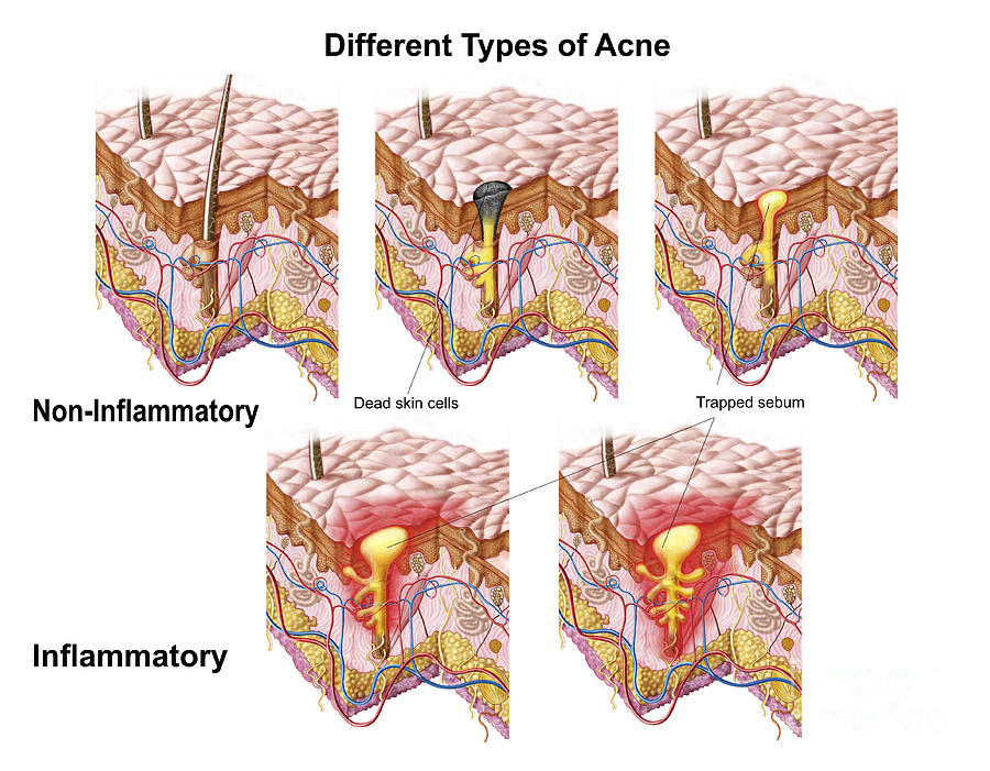 Horizontal Digital Art - Different Types Of Acne #1 by Stocktrek Images
