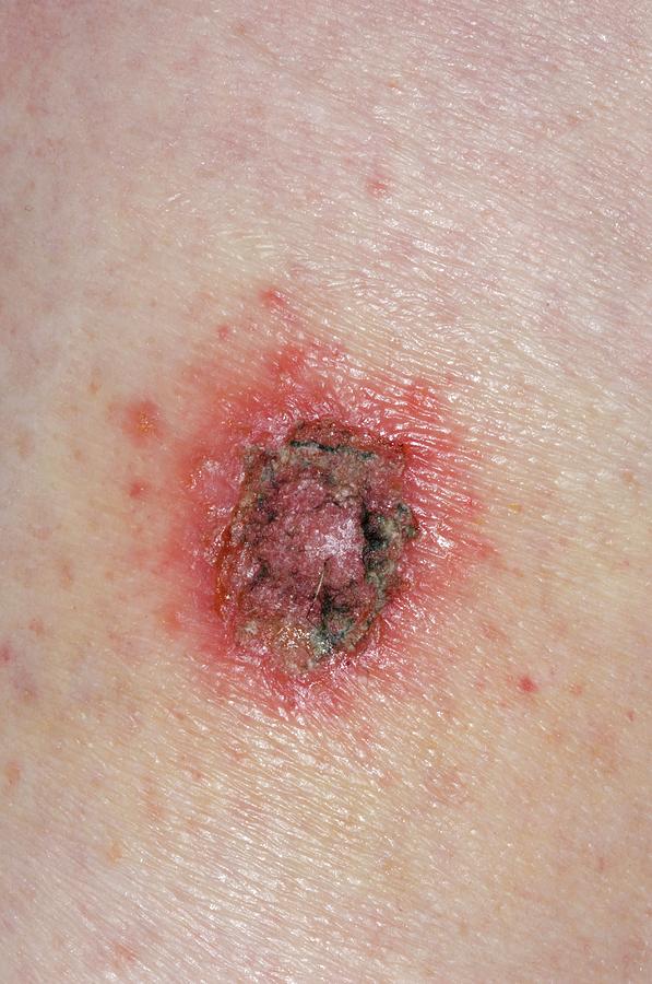 Discoid Eczema Photograph By Dr P Marazzi Science Photo Library