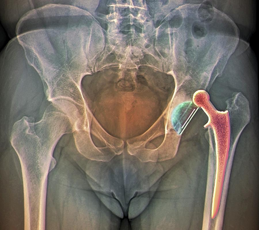 Xray Photograph - Dislocated Hip Replacement #1 by Zephyr/science Photo Library