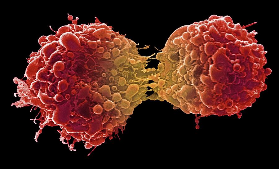 Dividing Bladder Cancer Cells Photograph By Steve Gschmeissner Science Photo Library Fine Art