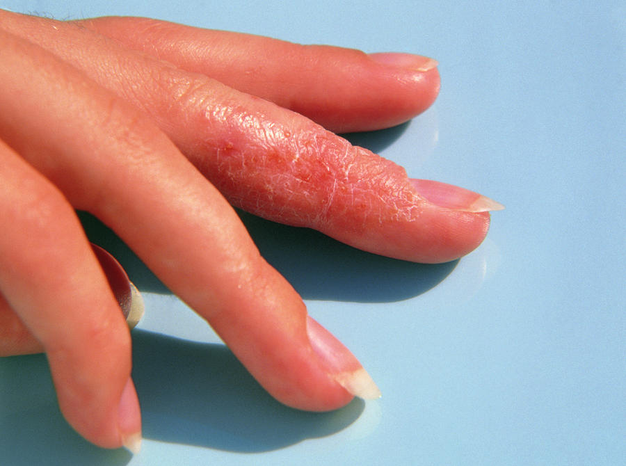 eczema-affecting-a-womans-s-finger-1-photograph-by-sheila-terry