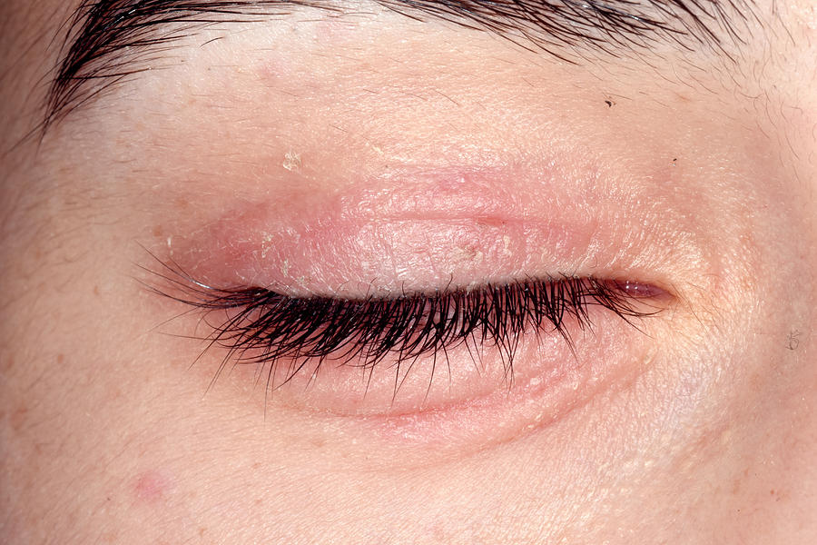 Eczema Around The Eye Photograph by Dr P. Marazzi/science Photo Library