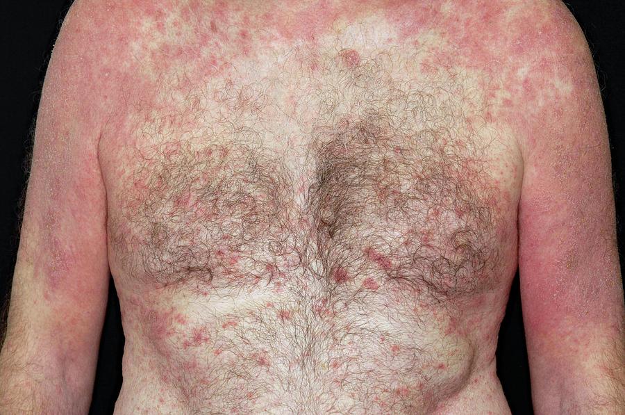 Eczema On The Torso Photograph By Dr P Marazzi Science Photo Library