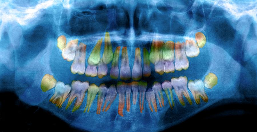 Emergence Of Adult Teeth #1 Photograph by Aj Photo/science Photo Library