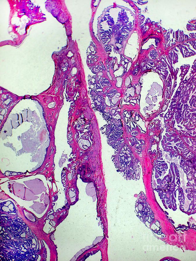 Endometrial Cancer, Lm #1 Photograph by Garry DeLong
