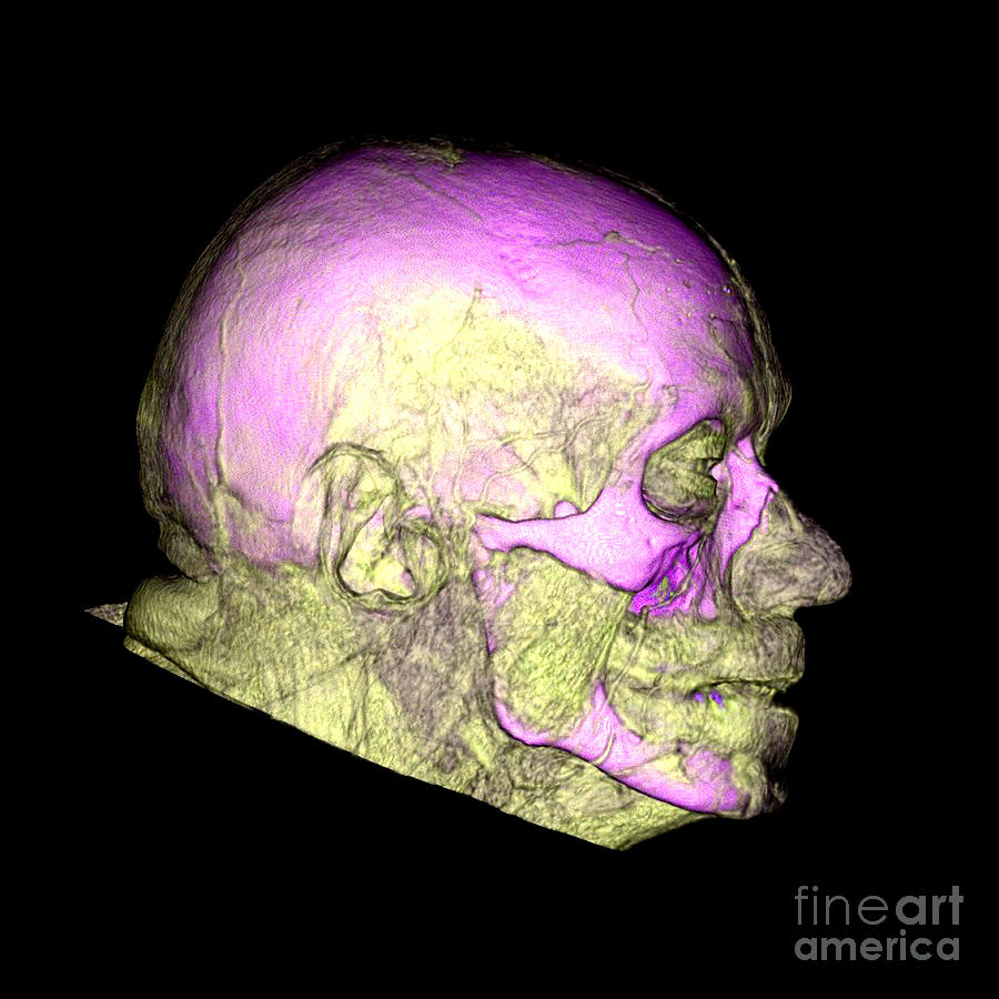 Enhanced 3d Ct Of Face And Skull #1 Photograph by Living Art Enterprises