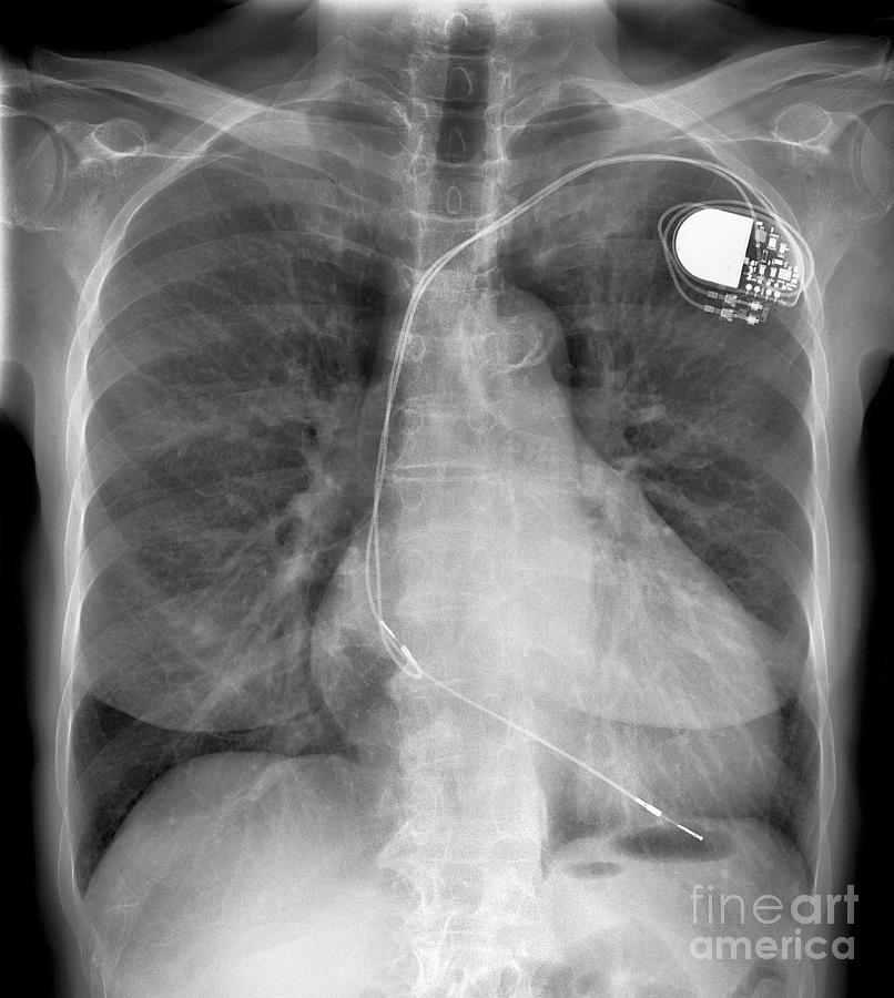 Enlarged Heart X Ray 1 Photograph By Science Photo Library Pixels Merch