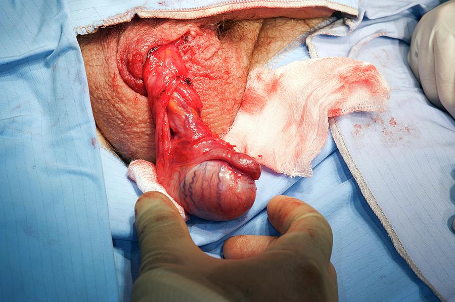 Epididymal Cyst Removal Surgery Photograph By Dr P Marazzi/science.