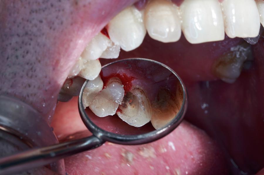 Examining Decayed Teeth Photograph by Dr Armen Taranyan / Science Photo ...