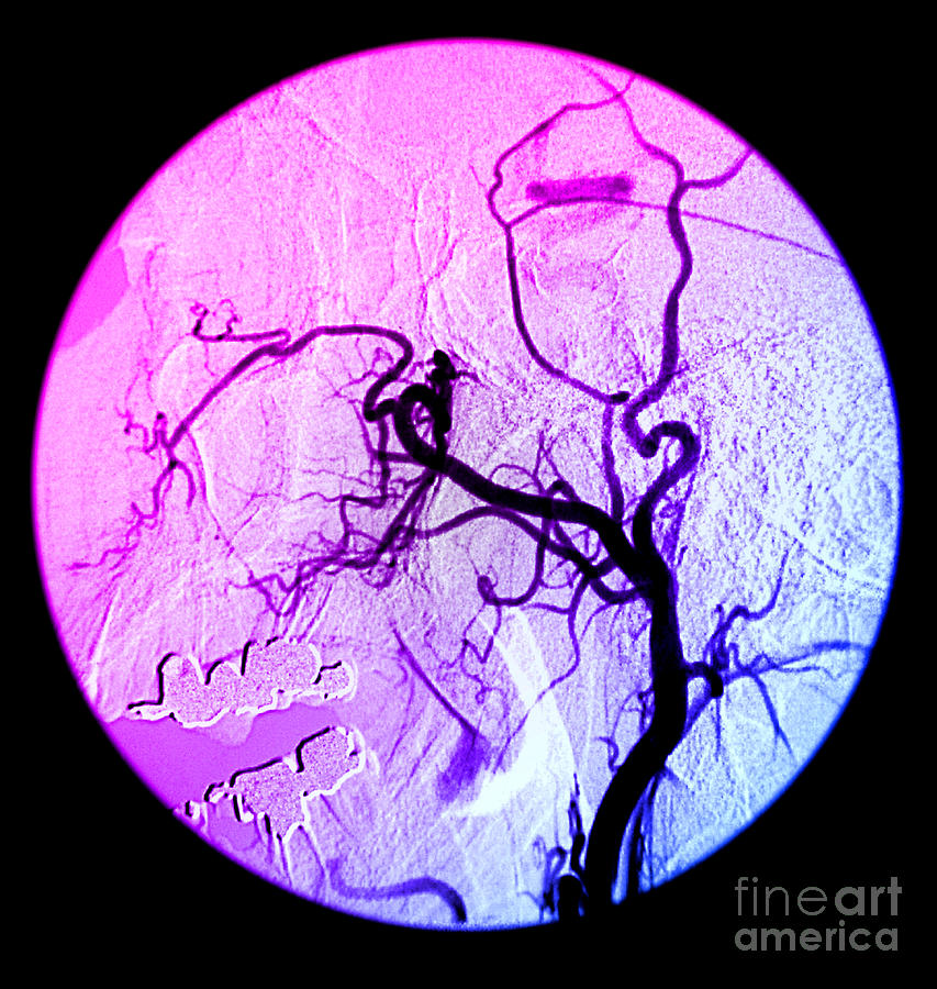 Arterial Angiogram Photograph - External Carotid Artery, Angiogram #1 by Living Art Enterprises