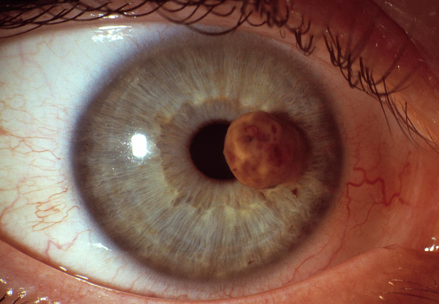 Eye Cancer Photograph by Sue Ford/science Photo Library