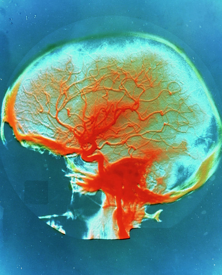 False-colour Arteriograph Of The Human Head #1 Photograph by Alain Pol, Ism/science Photo Library