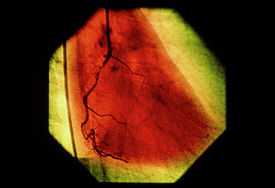 Angiogram Photograph - False-colour Coronary Angiogram: Stenosis #1 by Mehau Kulyk/science Photo Library