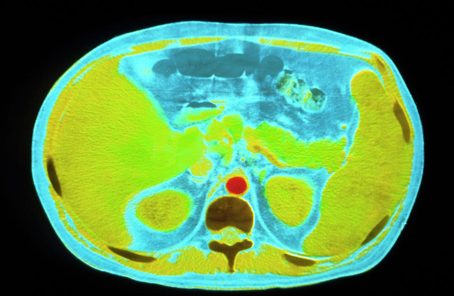 False-colour Ct Scan Of Liver #1 Photograph by Alain Pol, Ism/science Photo Library