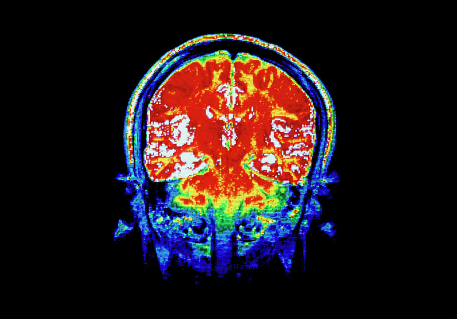 False-colour Frontal Mri Scan Of A Child's Head Photograph by Cnri ...