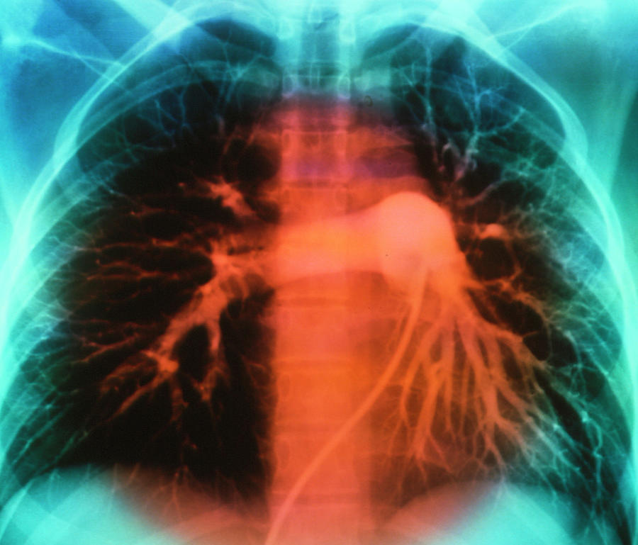 False-colour Normal Pulmonary Arteriogram #1 Photograph by Mehau Kulyk/science Photo Library