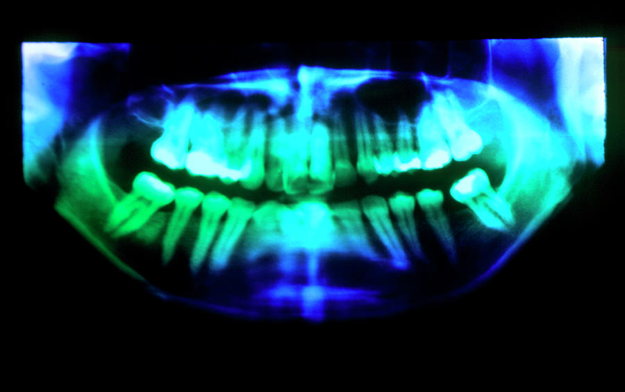 False-colour Pan-oral X-ray Showing Fillings #1 Photograph by George Bernard/science Photo Library