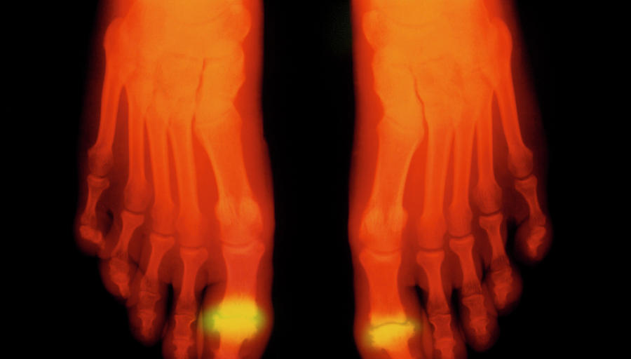 Xray Of Foot With Arthritis