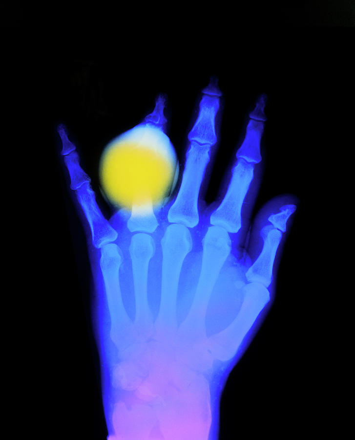 False-colour X-ray Of Hand In Gouty Arthritis #1 Photograph by Science Photo Library