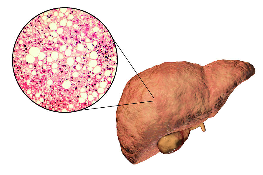 Fatty Liver Photograph By Kateryna Kon/science Photo Library | Fine Art ...