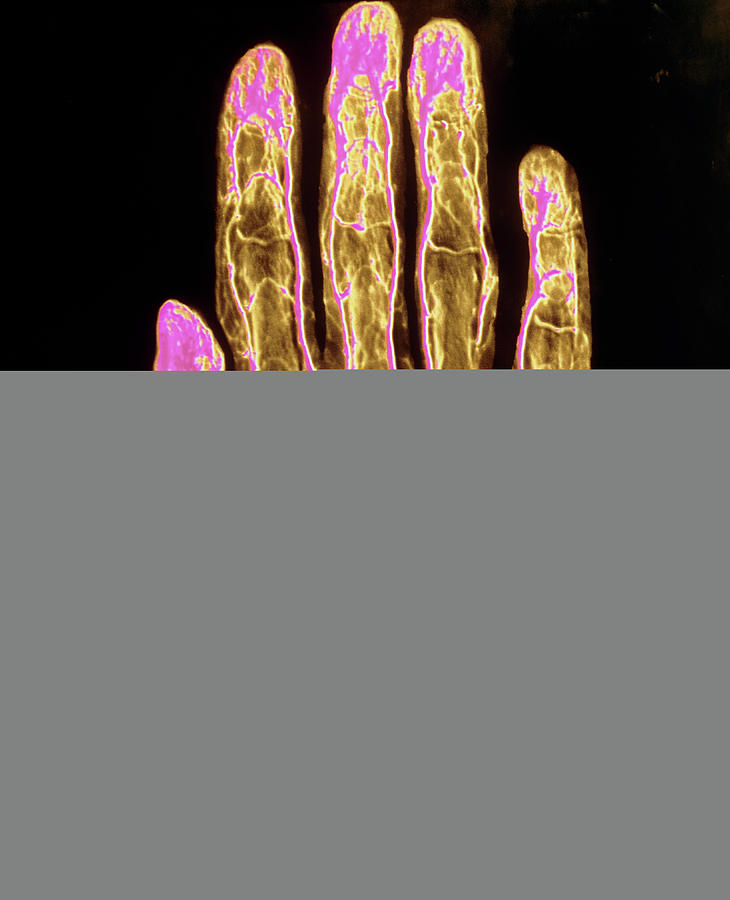 F/col Arteriogram Of Human Hand #1 Photograph by Alain Pol, Ism/science Photo Library