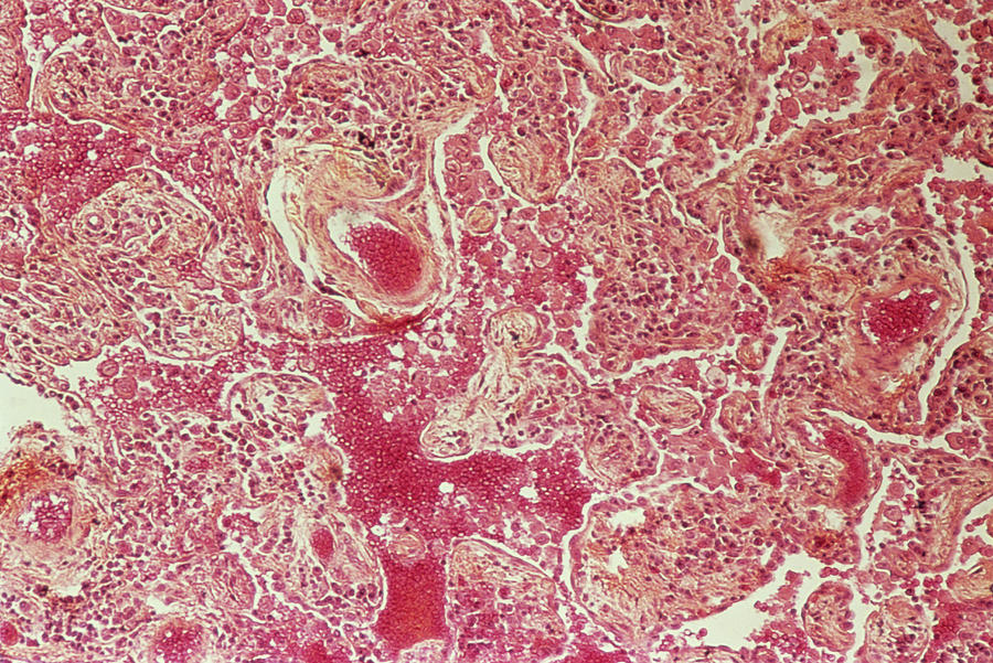 lung fibroblast