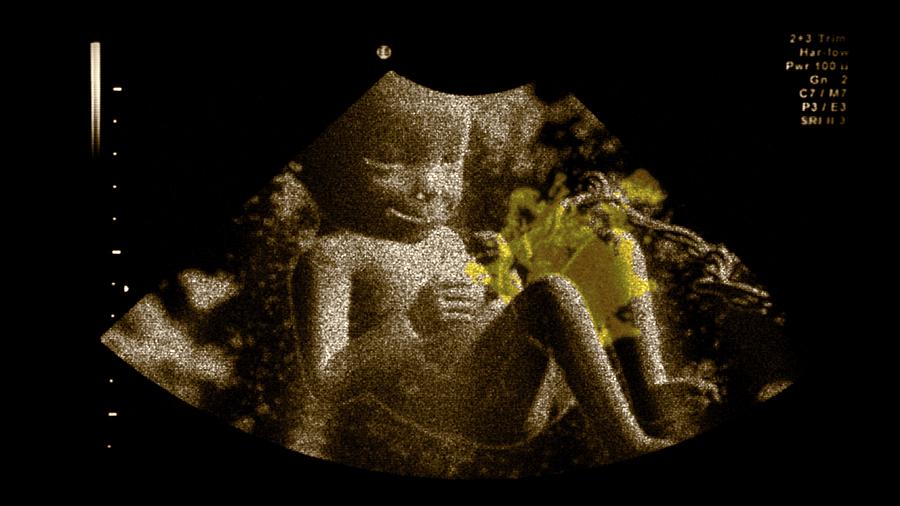 Foetus In The Womb #1 Photograph by Thierry Berrod, Mona Lisa Production
