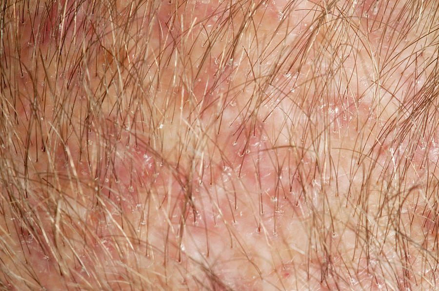 Folliculitis Of The Scalp Photograph By Mid Essex Hospital Services Nhs 